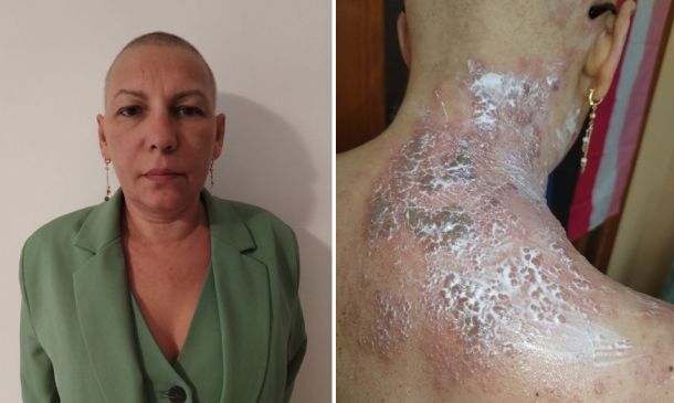 Side-by-side: a woman wearing a green blazer on the left and a close-up of severely itchy, peeling skin on the neck and shoulder on the right.